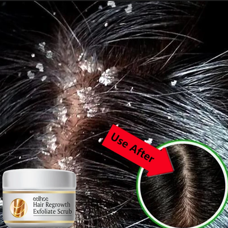 Scalp Scrub Exfoliant - Snelle Anti-roos Haarbehandeling Scrub Jeukherstel Hoofdhuidreiniging